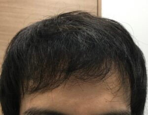 治療前の頭髪：前