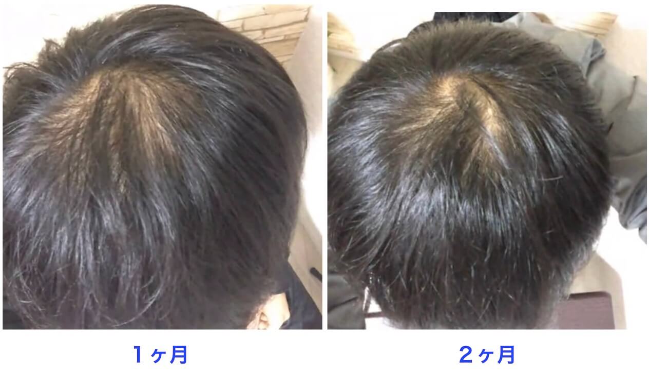 治療開始2ヶ月の比較写真。頭頂部。