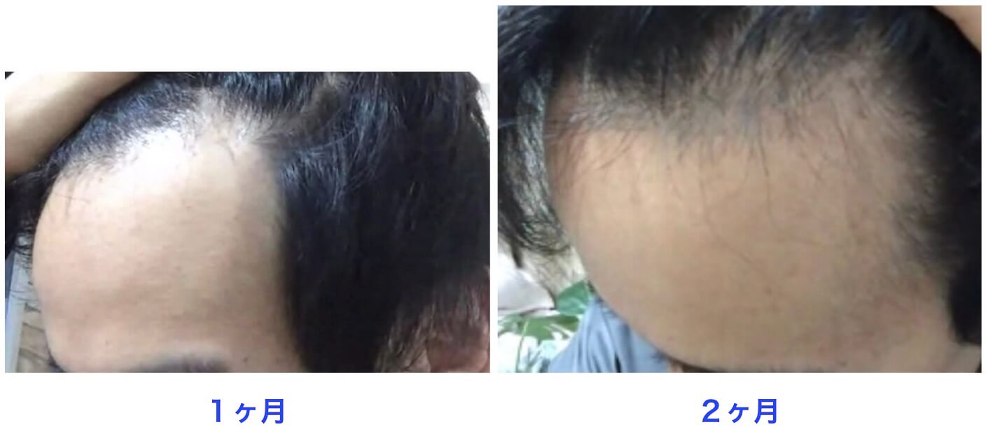 治療開始2ヶ月後の比較写真。生え際の左。