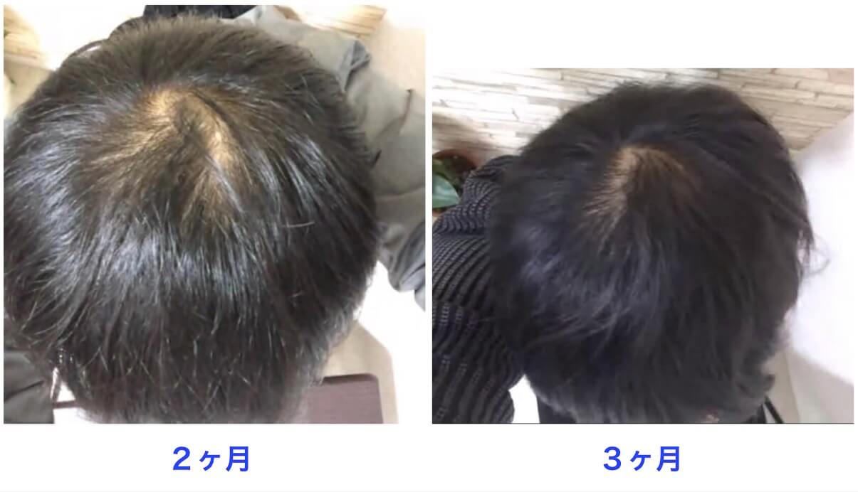 治療開始3ヶ月の比較写真。頭頂部。