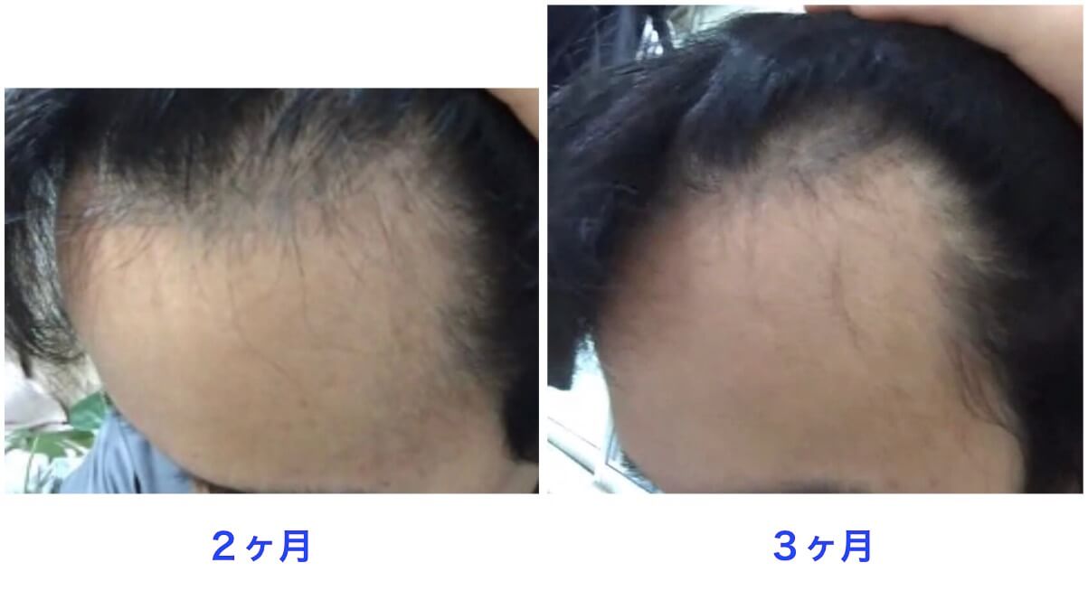 治療開始3ヶ月後の比較写真。生え際の左。
