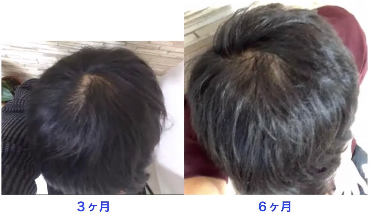 治療開始6ヶ月の比較写真。頭頂部。