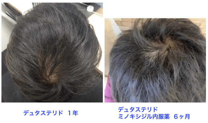 AGA治療ミノキシジル６ヶ月の結果：頭頂部