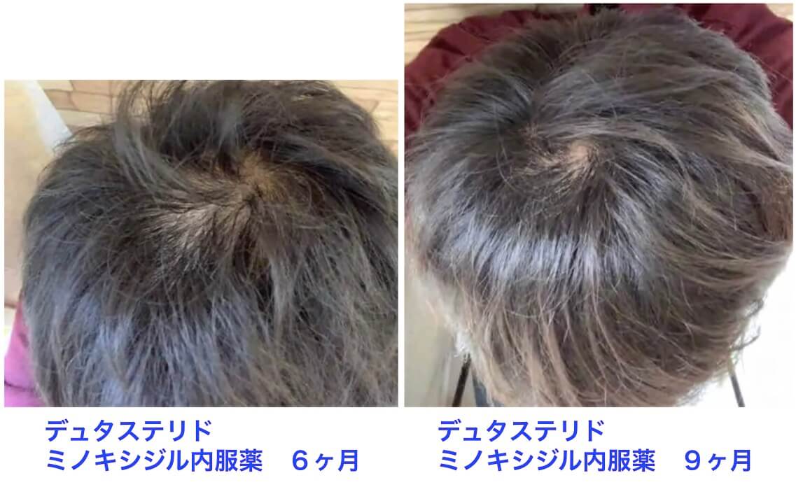 AGA治療ミノキシジル9ヶ月の結果：頭頂部
