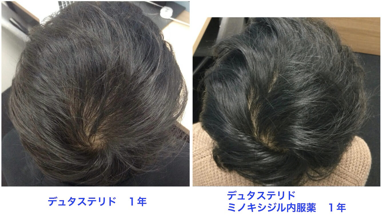 AGA治療ミノキシジルを服用して１年の結果：頭頂部